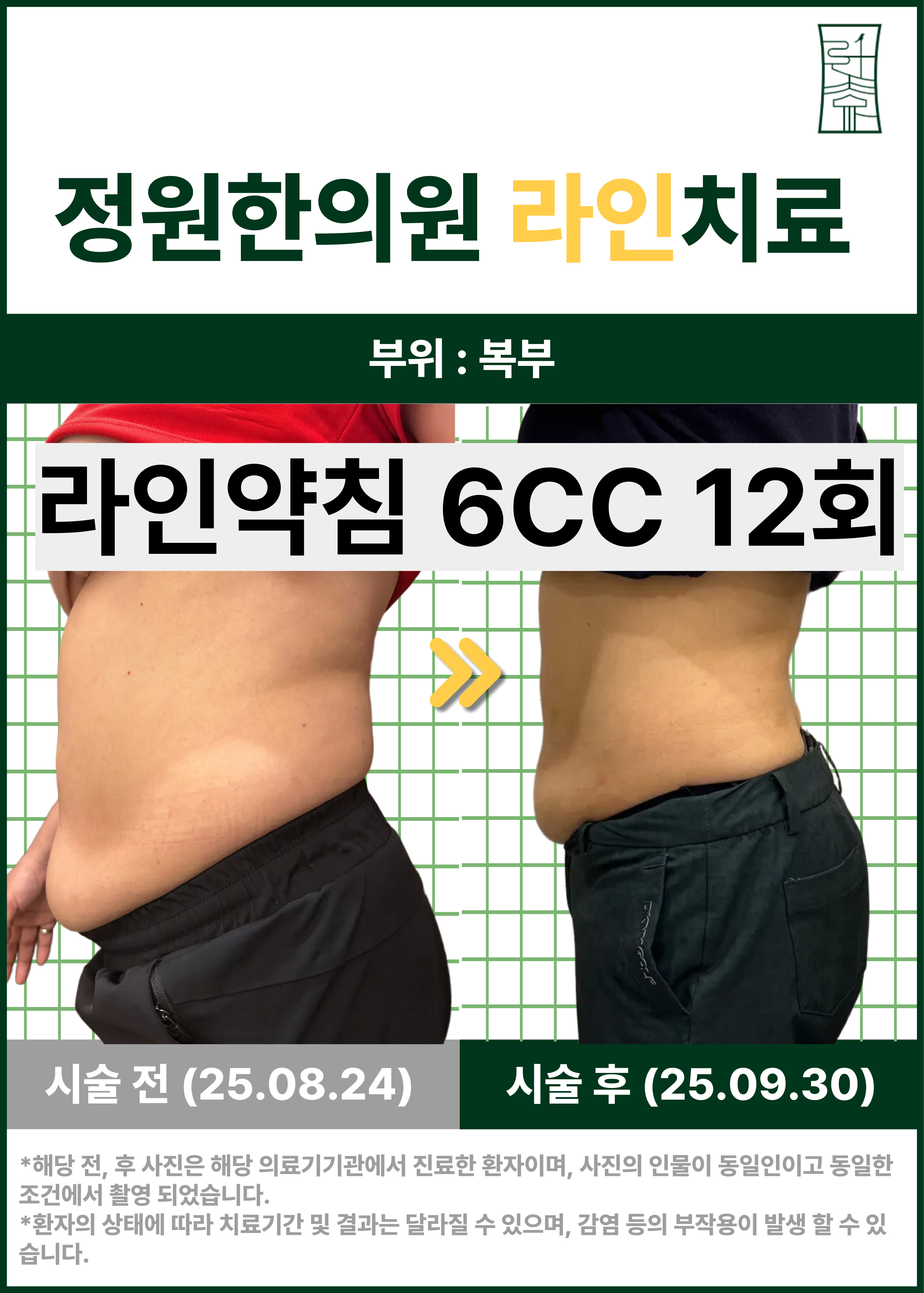 복부 라인 약침 관리 사례 치료 전