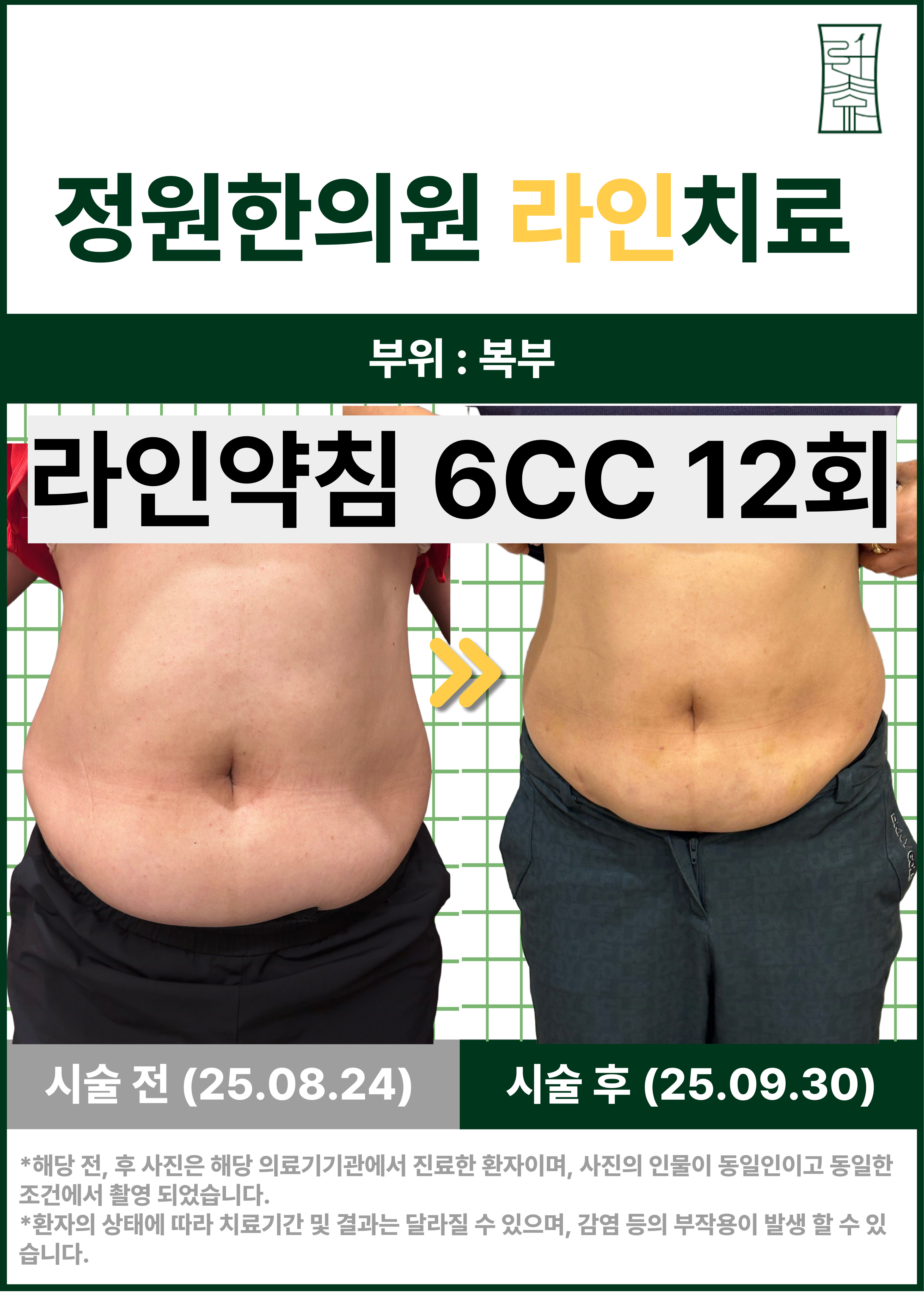 복부 부분 관리를 위한 라인 약침 치료 사례 치료 전