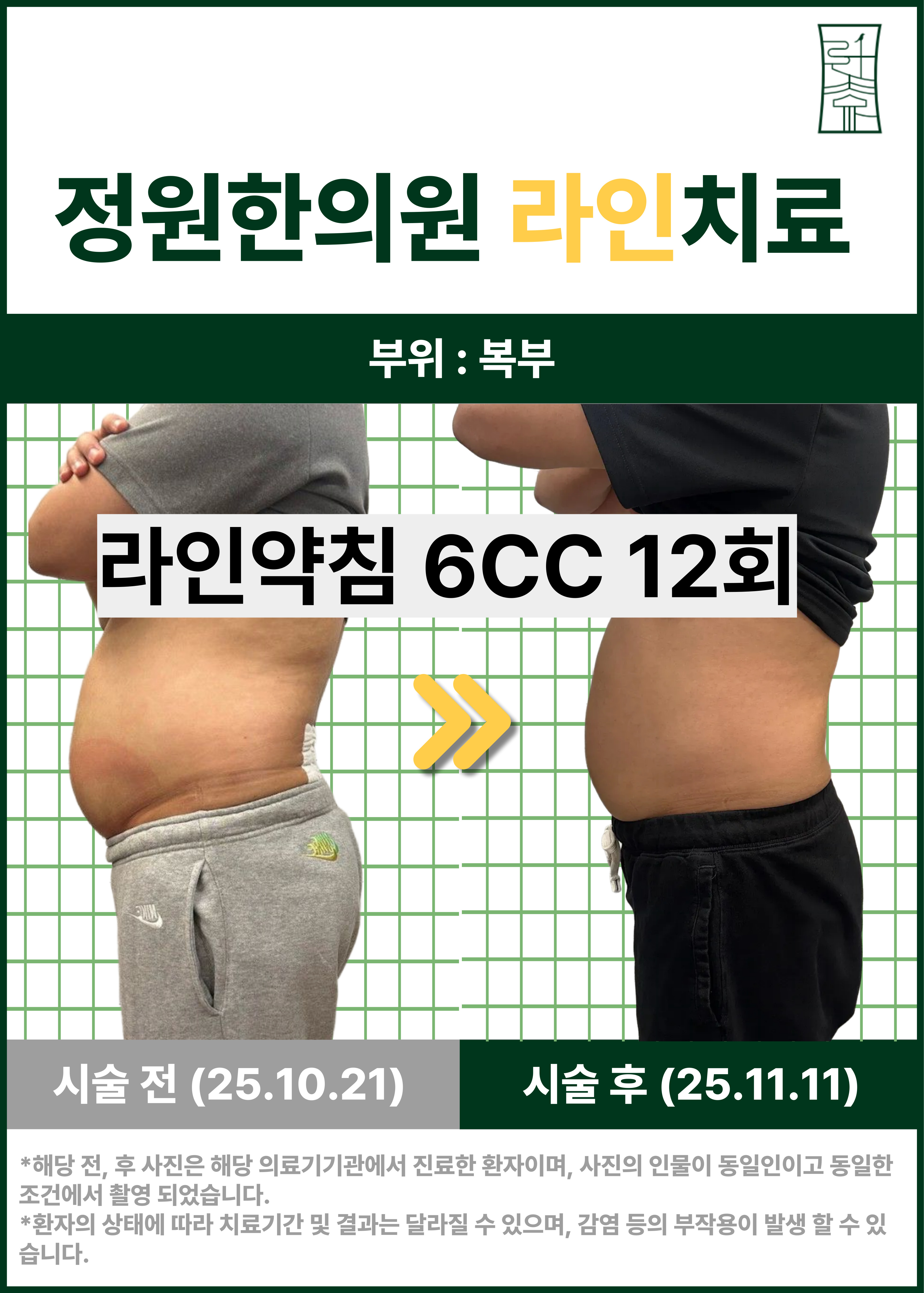 복부 라인 약침 관리 사례 치료 전