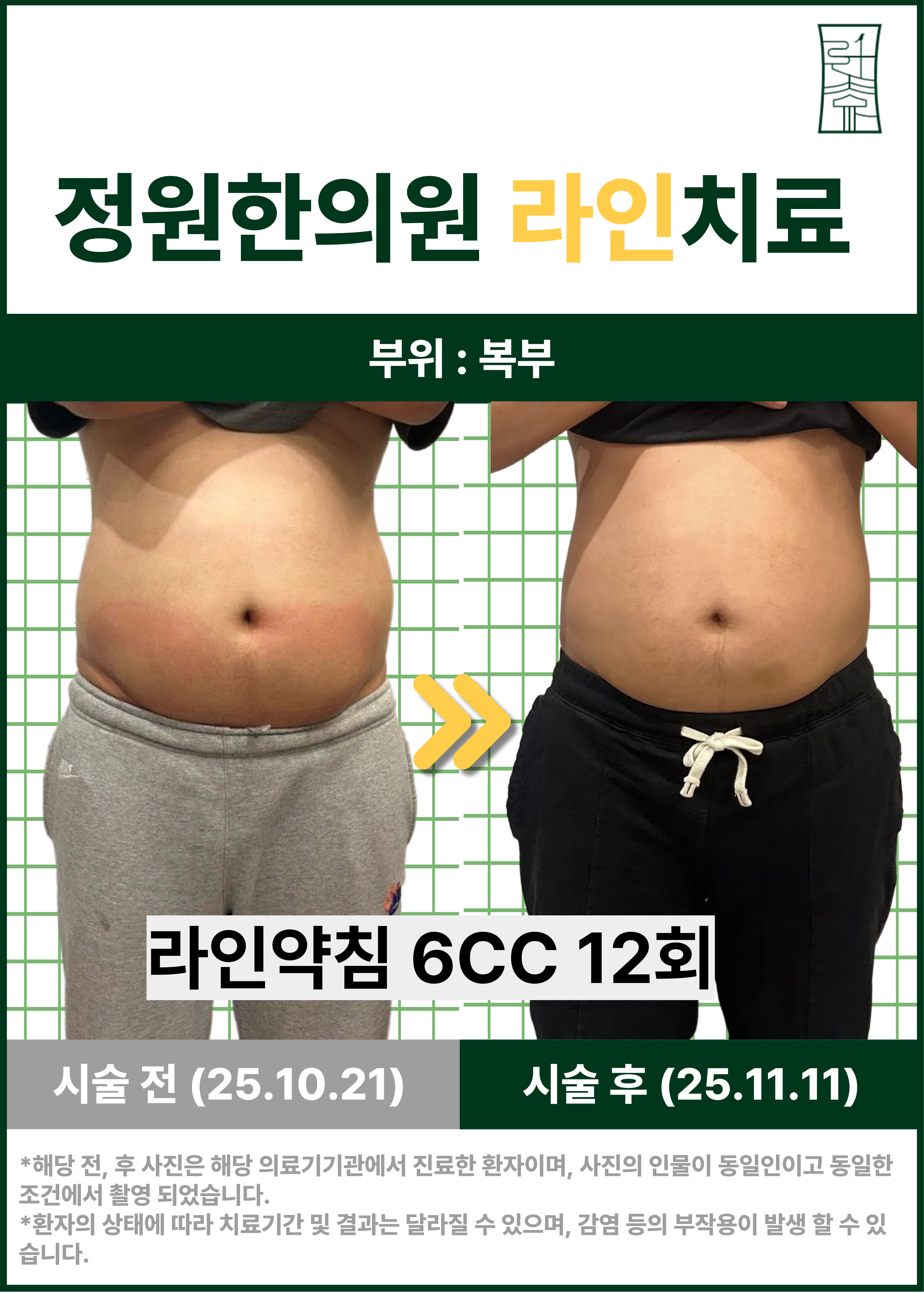 치료 전