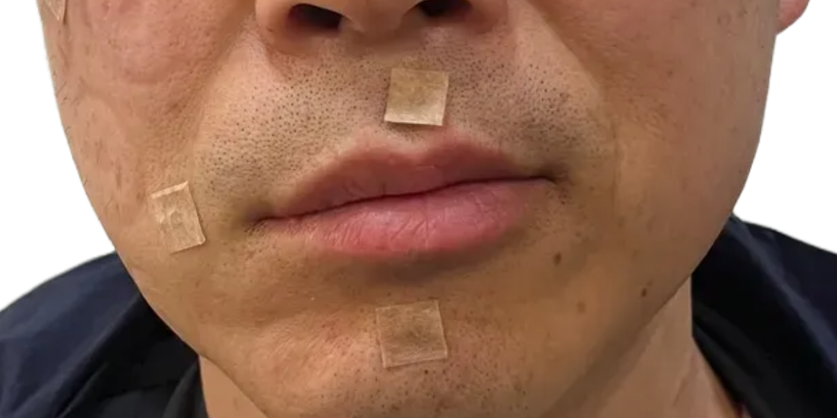 안면마비 치료 후기 - 2주 정도부터 입술과 눈썹 위치가 제자리를 잡았어요 치료 전