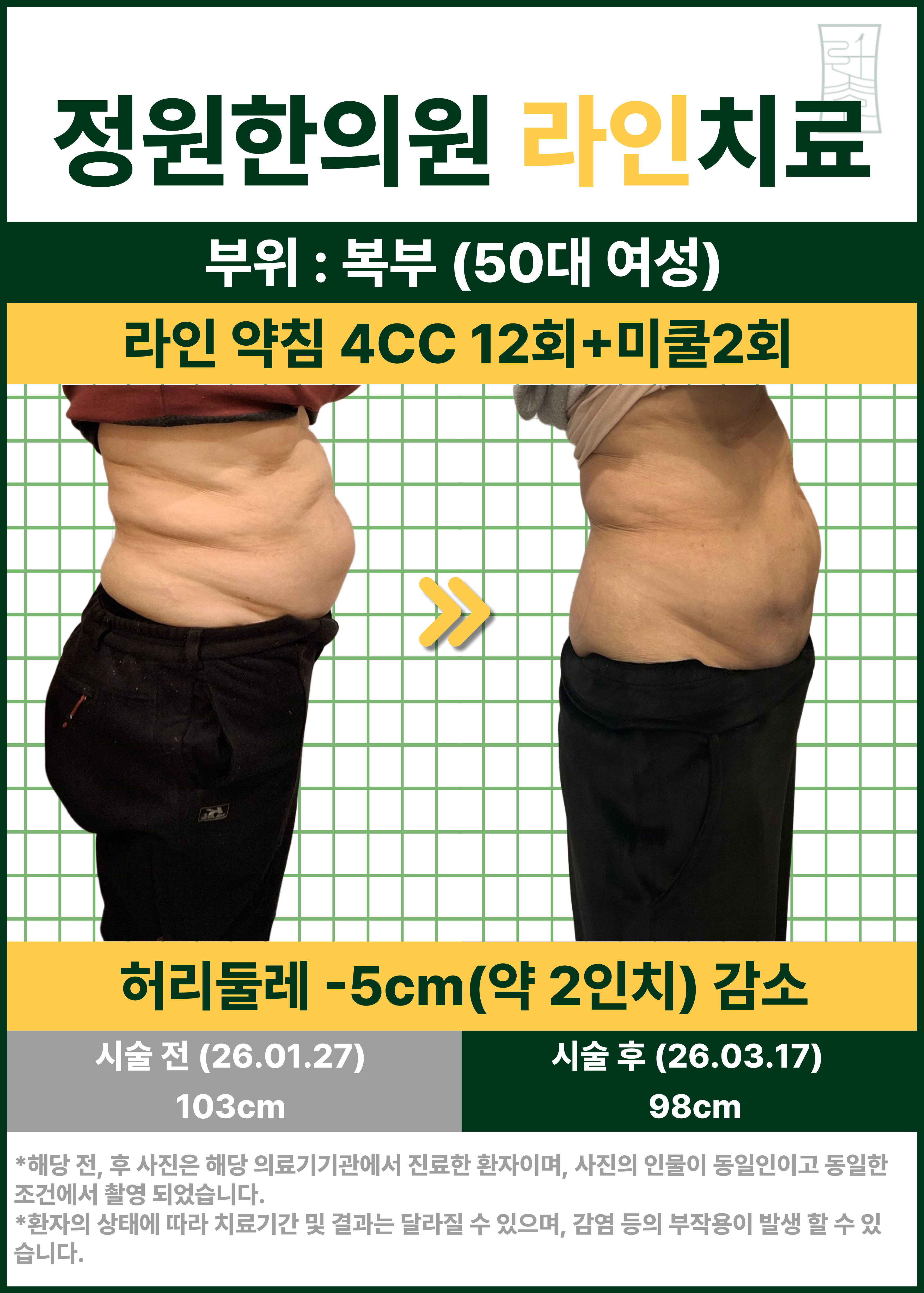 복부 라인 약침·미쿨 병행 관리 사례 (50대 여성) 치료 전