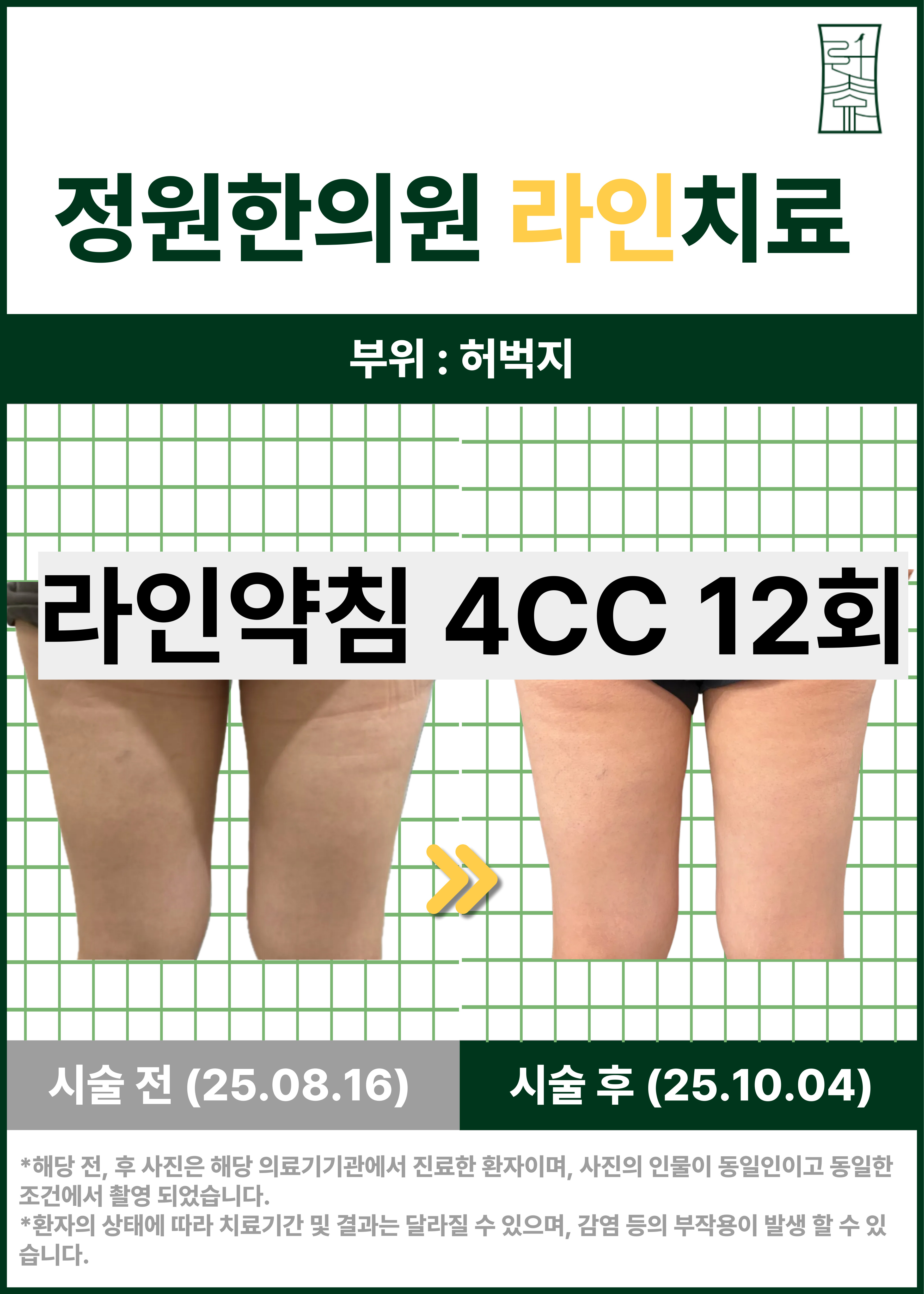 허벅지 라인 약침 관리 사례 치료 전